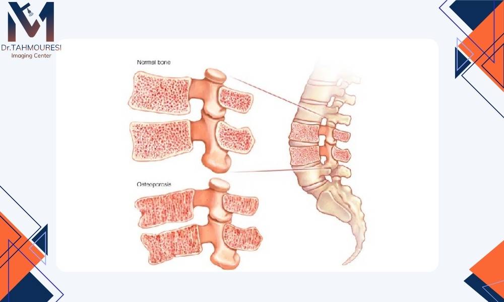 پوکی استخوان چیست و چرا زنان بیشتر در معرض آن هستند؟