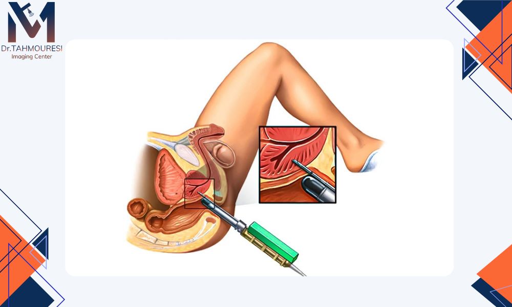 روش‌های مختلف بیوپسی پروستات کدامند؟