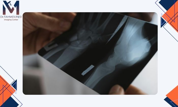 چالشها و مشکلات در تشخیص ترک استخوان چالشها و مشکلات در تشخیص ترک استخوان