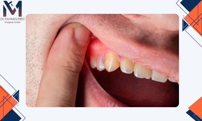 علت‌های شایع تشکیل کیست فک