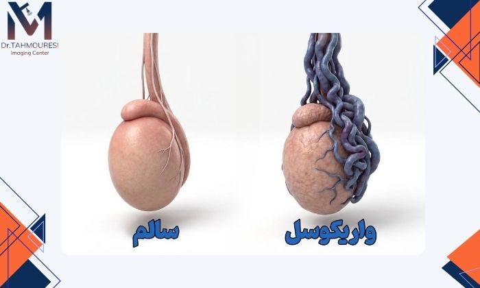 چه بیماری‌هایی با سونوگرافی اسکروتوم تشخیص داده می‌شوند؟